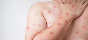 Mpox em MT: Secretaria Estadual de Saúde reforça alerta