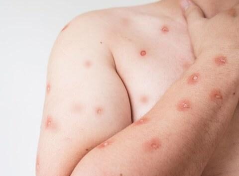 Mpox em MT: Secretaria Estadual de Saúde reforça alerta