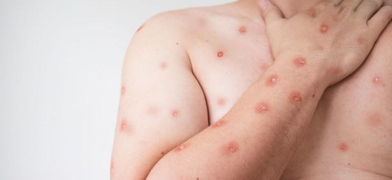 Mpox em MT: Secretaria Estadual de Saúde reforça alerta